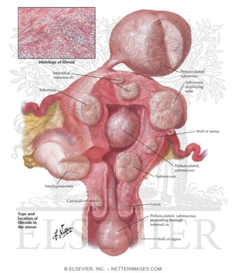 Myoma Fibroid I Locations