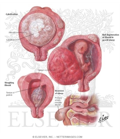 Myoma (Fibroid) II - Secondary Changes