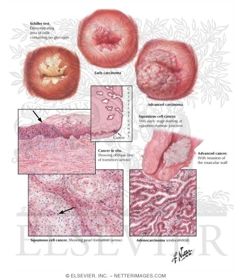 Cancer of Cervix II - Various Stages and Types