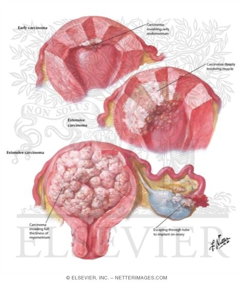 Watermarked preview of labeled image: Cancer of Corpus I - Various Stages and Types
