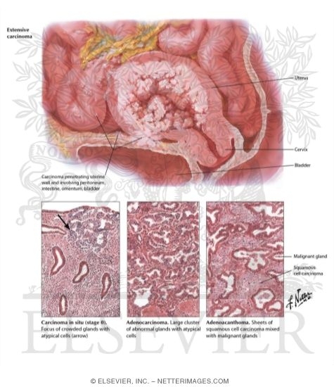 Watermarked preview of labeled image: Cancer of Corpus II - Histology and Extension