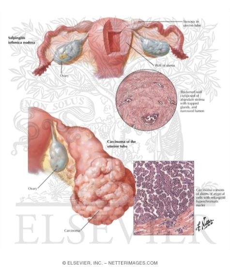 Salpingitis Isthmica Nodosa, Carcinoma