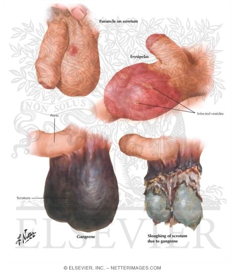 Infection and Gangrene of the Testis