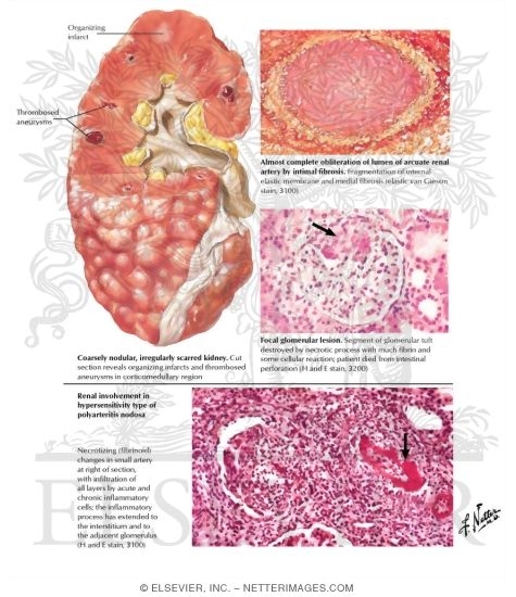 Polyarteritis Nodosa