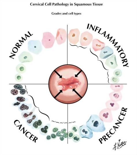 Abnormal Pap Smear: ASCUS or AGCUS
Cervical Cell Pathology in Squamous Tissue