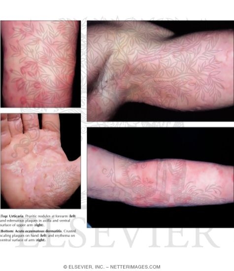 Watermarked preview of labeled image: Urticaria and Acute Eczematous Dermatitis