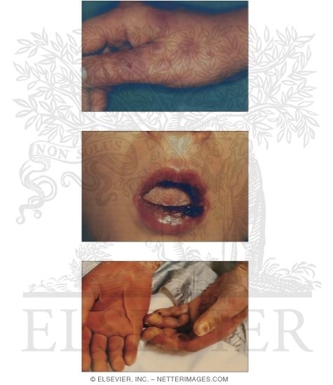 Erythema Multiforme