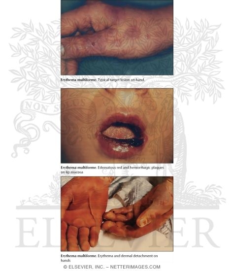 Watermarked preview of unlabeled image: Erythema Multiforme