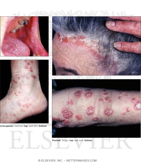 Lichen Planus and Psoriasis