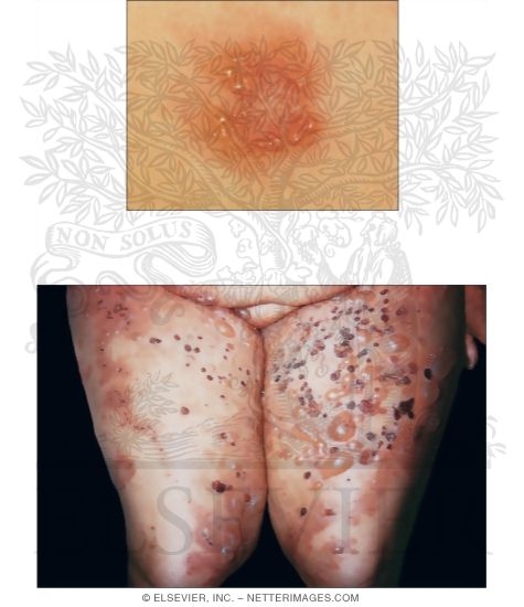 Dermatitis Herpetiformis and Pemphigus Vulgaris