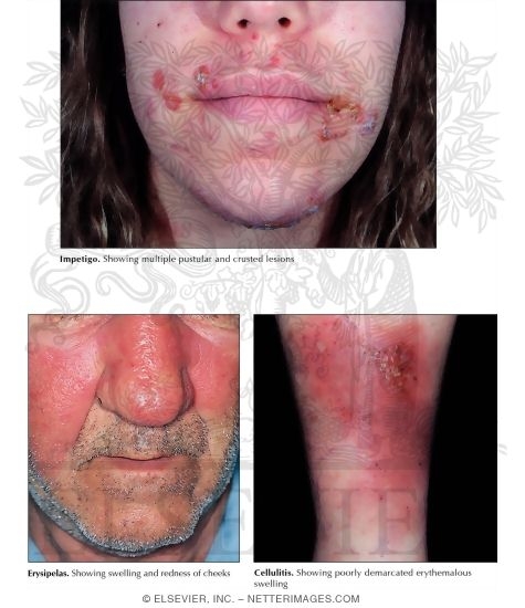 Impetigo, Cellulitis, and Erysipelas