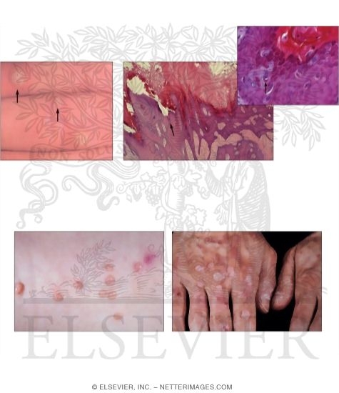 Miscellaneous Viral Skin Infections