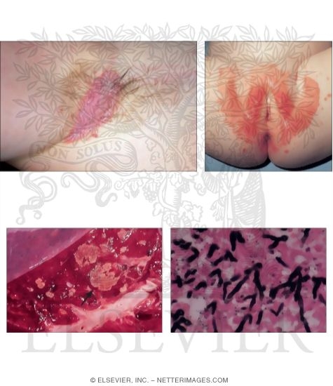 Dermal Candidiasis