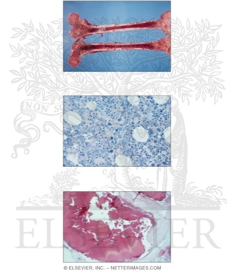 Polycythemia Vera