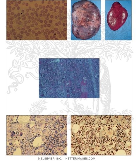 Watermarked preview of unlabeled image: Osteomyelofibrosis