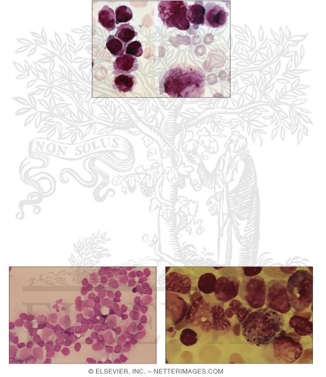 Acute Myelomonocytic Leukemia Subtypes M4 and M5