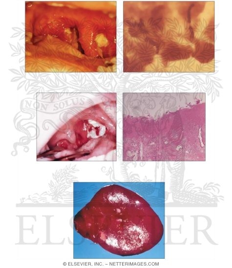 Suppurative Inflammation