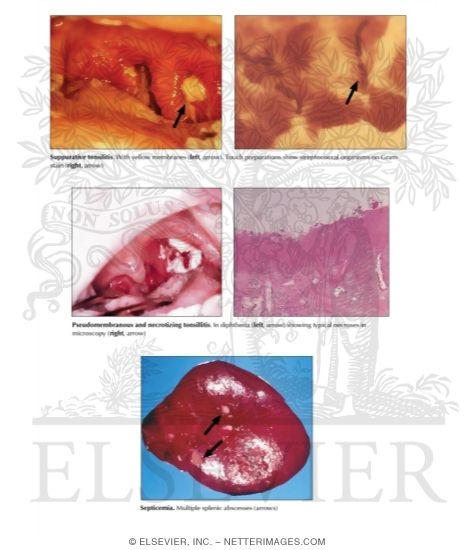 Suppurative Inflammation