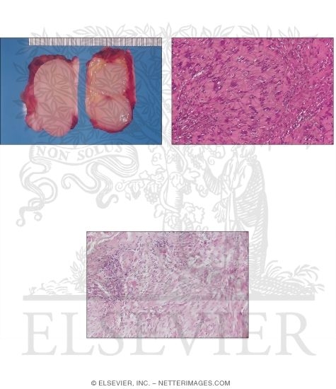 Benign Soft Tissue Tumors