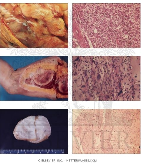 Malignant Soft Tissue Tumors