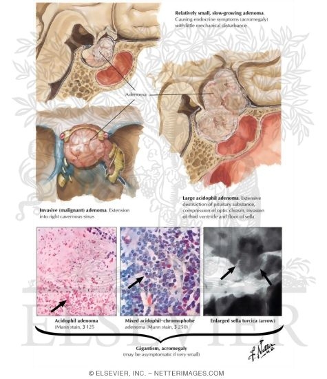 Watermarked preview of labeled image: Acidophil Adenoma