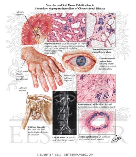 Watermarked preview of labeled image: Tissue Calcification