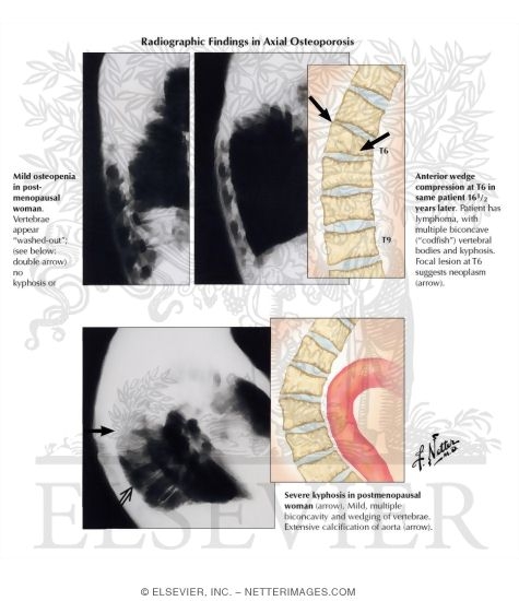 Watermarked preview of labeled image: Clinical Manifestations of Osteoporotic Vertebral Compression Fractures
