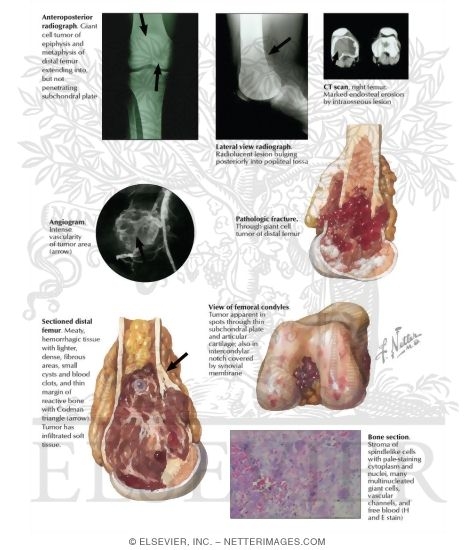Giant-Cell Tumor of Bone