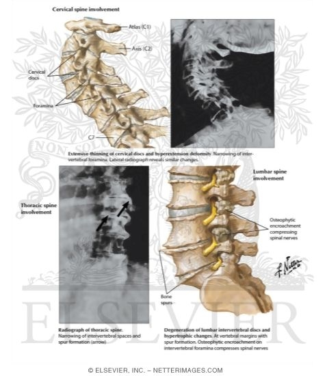Spine Involvement In Osteoarthritis