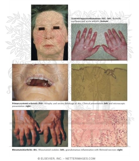 Collagen-Vascular Disease