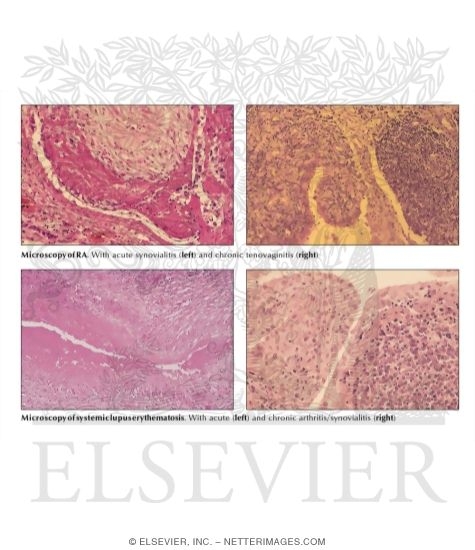 Watermarked preview of labeled image: Collagen-Vascular Disease
