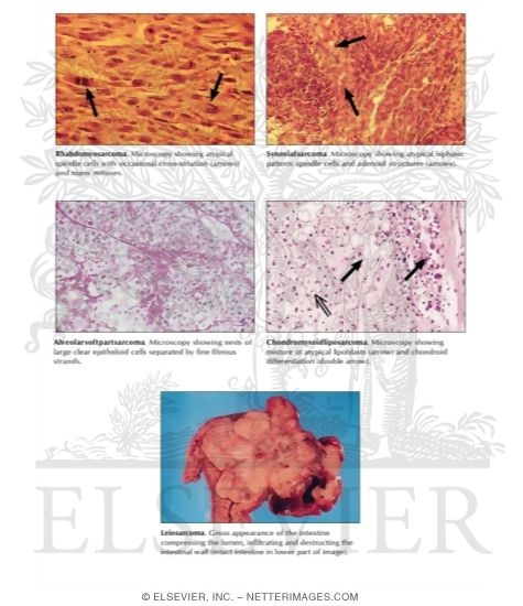 Watermarked preview of labeled image: Malignant Soft Tissue Tumors
