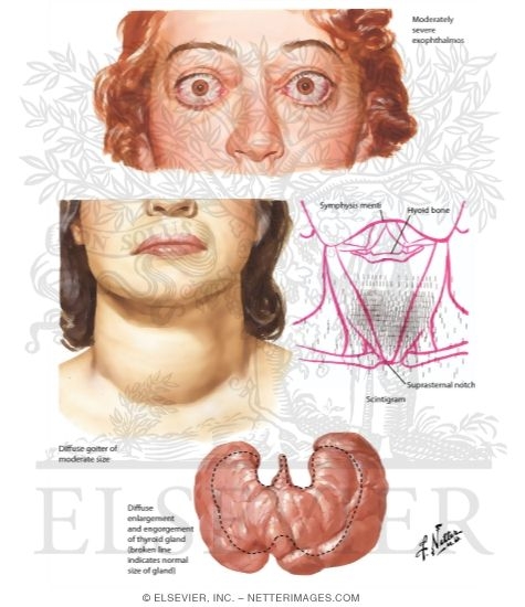 Graves Disease: Thyroid and Ocular Pathology