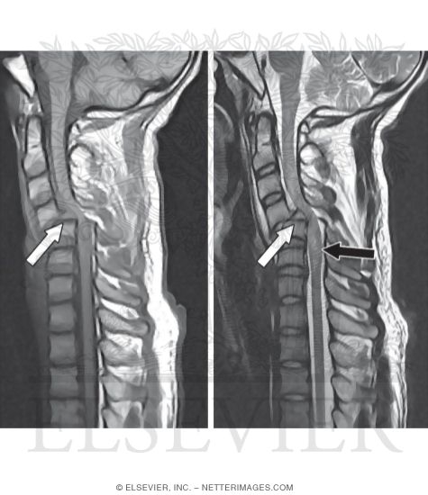Watermarked preview of unlabeled image: Cervical Spine Trauma, Sagittal T1 and T2