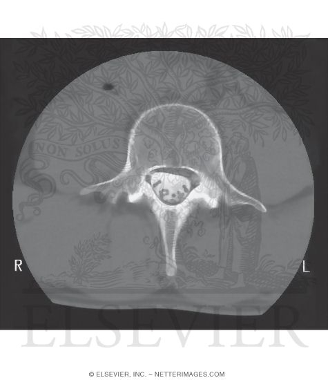 Axial CT Scan of Lumbar Vertebra