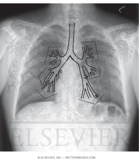 Watermarked preview of unlabeled image: Radiograph of Bronchii