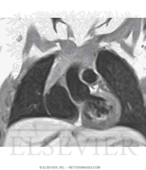 Coronal, T1 Weighted MR Scan of Surfaces and Borders of Heart
