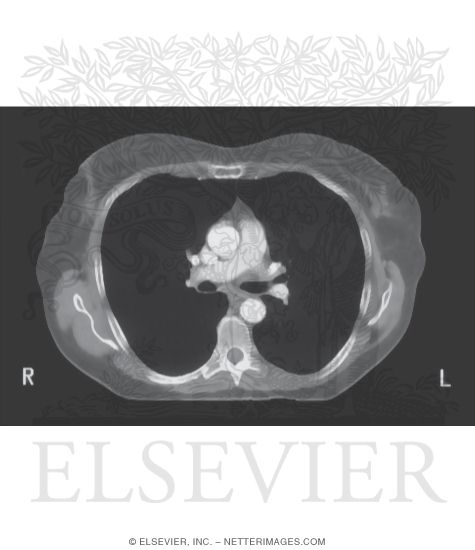 Axial CT Scan of Trachea and Esophagus