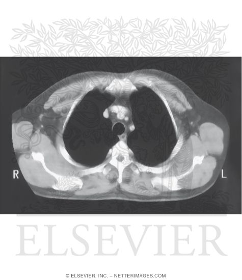 Axial CT Scan of Chest With Azygos and Hemiazygos Veins