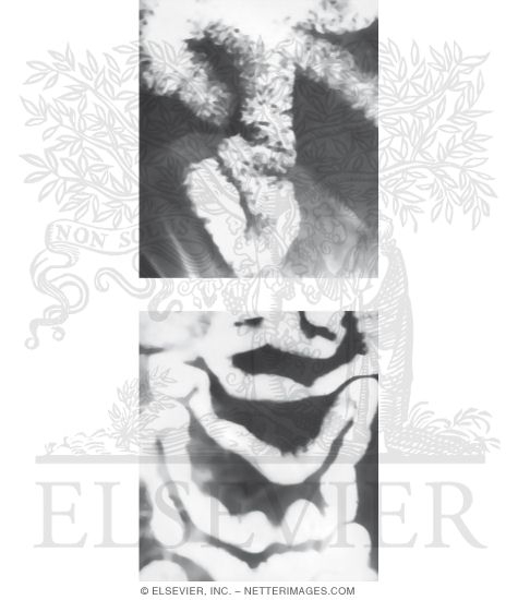 Barium Radiographs of Jejunum and Ileum