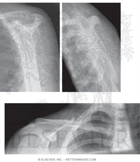 Shoulder: Supraspinatus, Scapular, and Clavicle