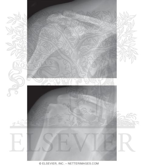 Shoulder: AP Views