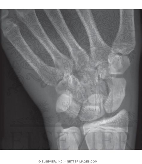 Scaphoid: AP View