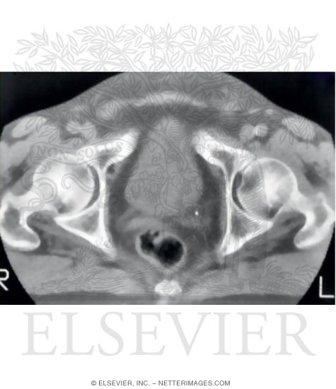 Watermarked preview of unlabeled image: Hip: CT