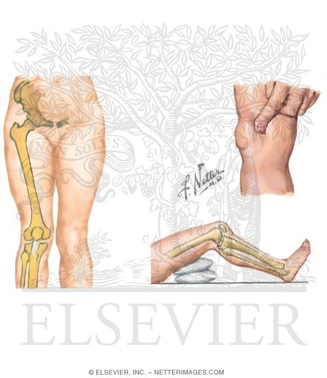 Tests for Dislocation of Patella