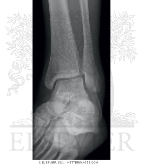 Ankle: Mortise