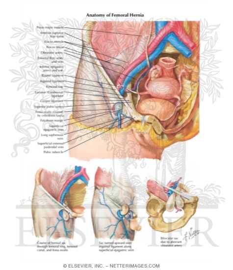 Femoral Hernias