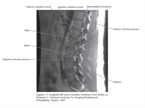 Sagittal, T1-weighted MR Scan of Lumbar Vertebrae