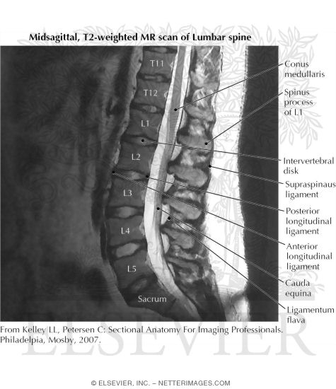 Midsagittal, T2-weighted MR Scan of Lumbar Spine