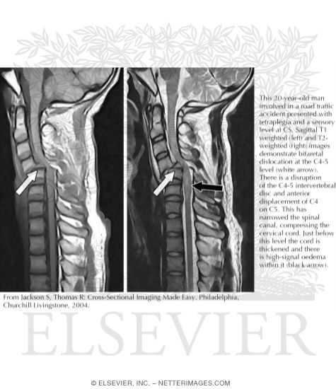 Watermarked preview of unlabeled image: Cervical Spine Trauma, Sagittal T1 and T2